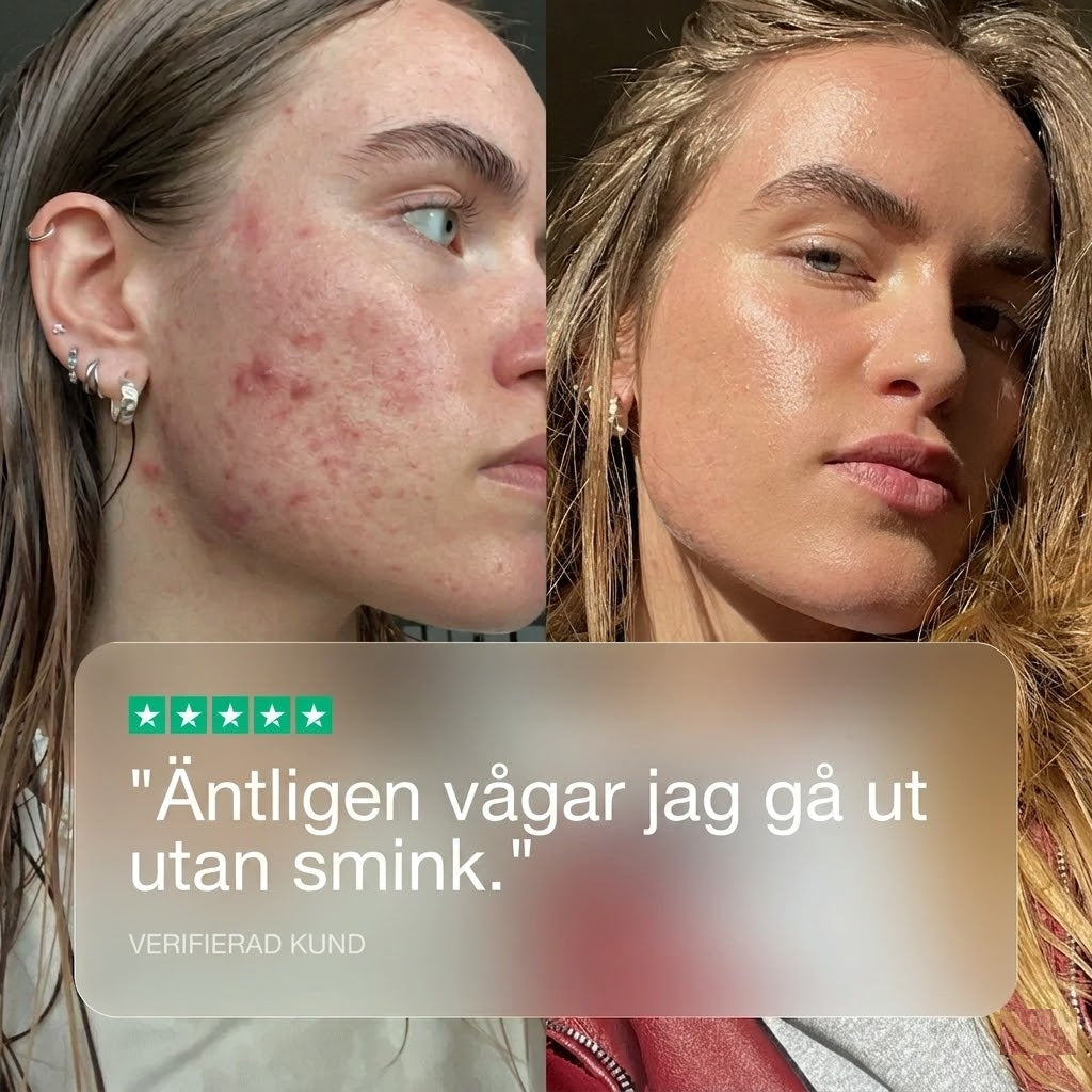 Clear+| 100 % naturligt stöd för hud som är benägen att få finnar.