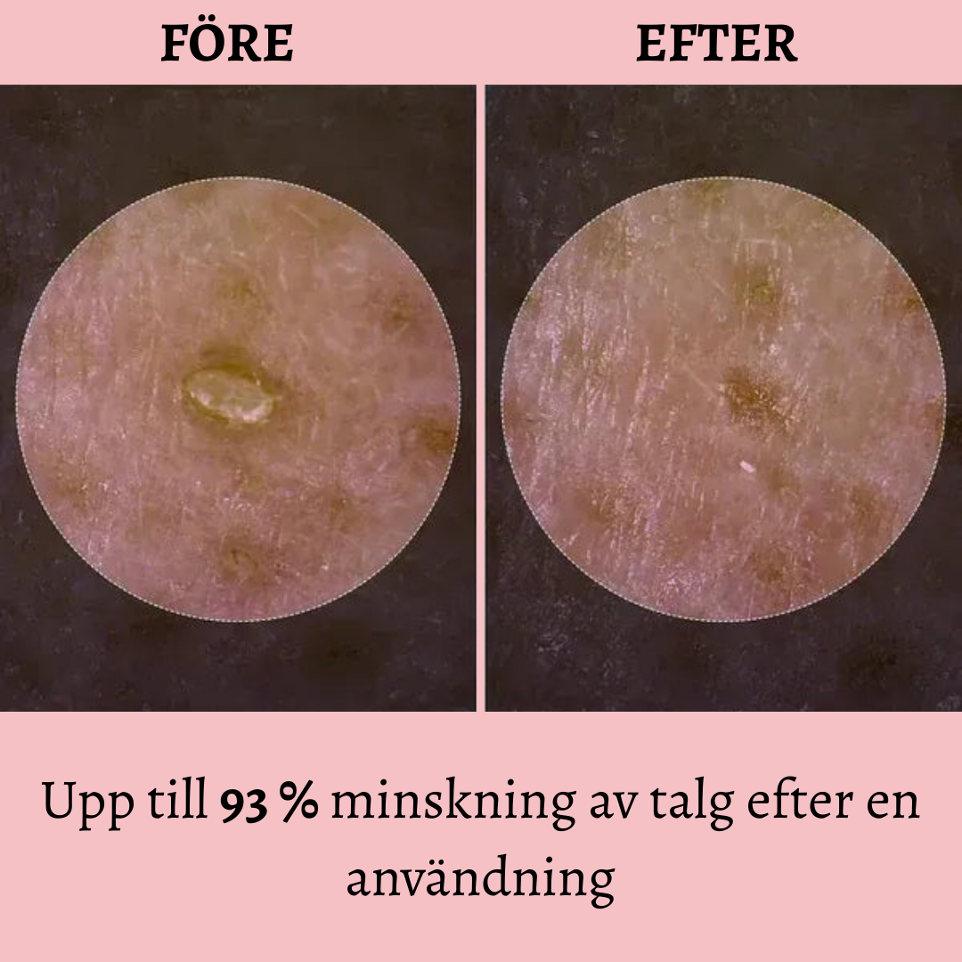 Lysteria- Synligt mindre porer inom 7 dagar