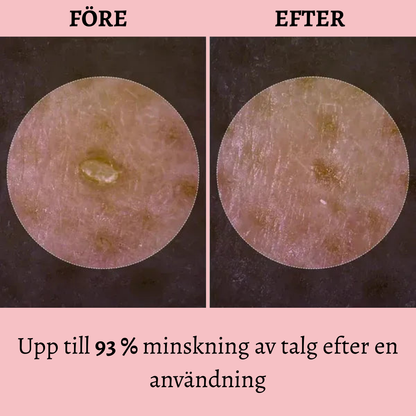 Lysteria- Synligt mindre porer inom 7 dagar