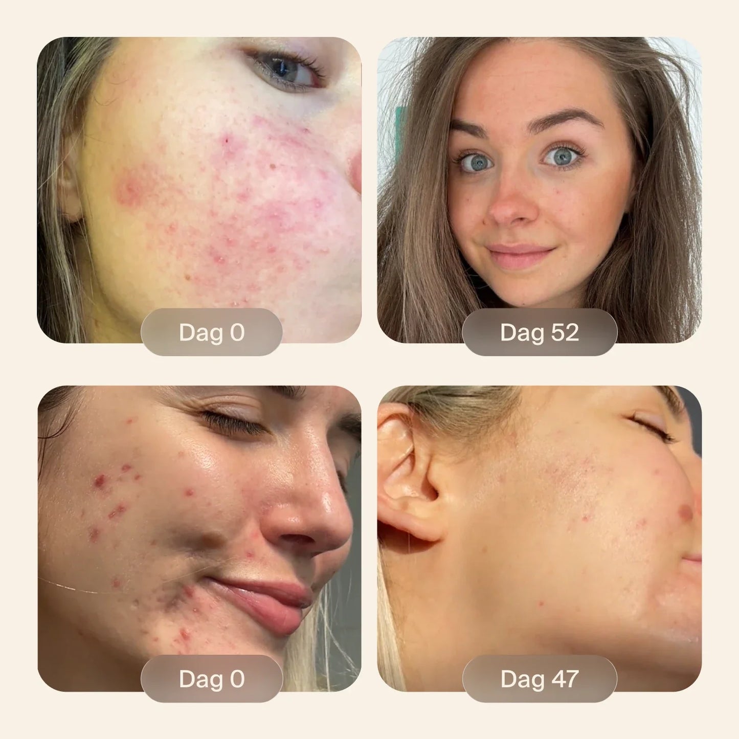 Clear+| 100 % naturligt stöd för hud som är benägen att få finnar.